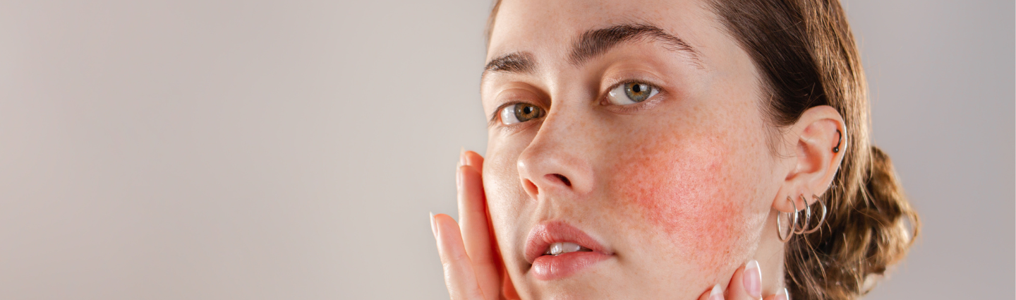 Frau mit Rosacea betrachtet sich im Spiegel.