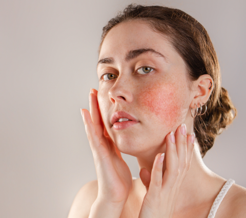 Frau mit Rosacea betrachtet sich im Spiegel.